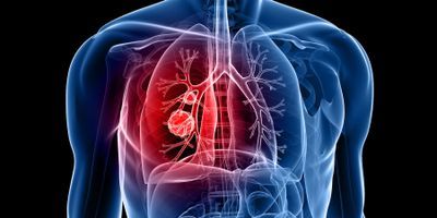 FDA approves new treatment for NSCLC