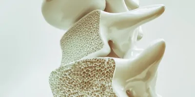 3D rendering of osteoporosis in the spine.
