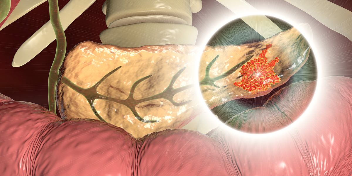 Knocking down the walls that make pancreatic tumors unreachable