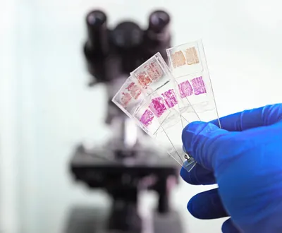 An image of three glass slides with pathology tissue samples on them and a microscope in the background.
