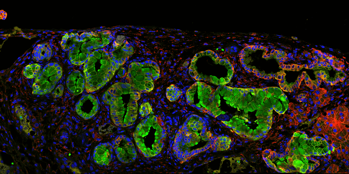 tirzepatide pancreatic cancer Possible pro-oncogenic effect of (TRZD) on the pancreas, Mounjaro & Pancreatic Cancer: Debunking