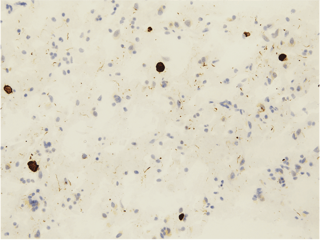 A microscopic image of Lewy bodies on a white background. A microscopic image of Lewy bodies on a white background.