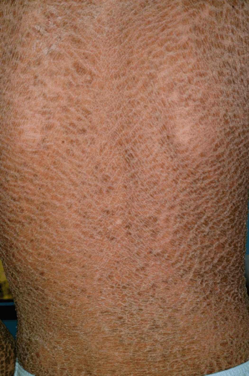 A photo of an ichthyosis patient’s back.