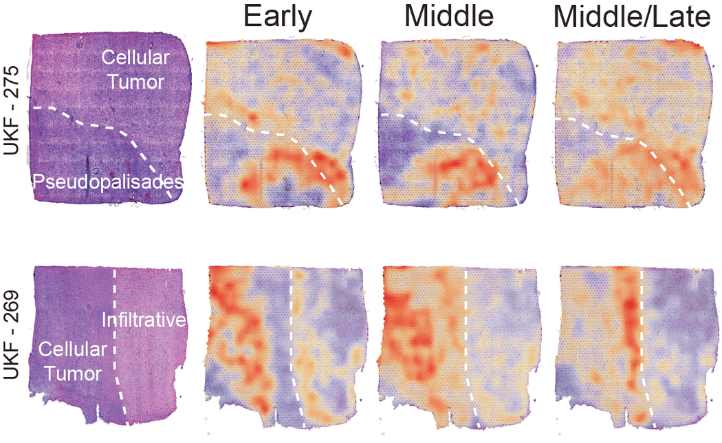 Spatial transcriptomics visualizations for early, middle, and middle/late stages of glioblastoma tumor tissues.