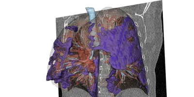 AI image simulation of a human lung created from historic imaging data