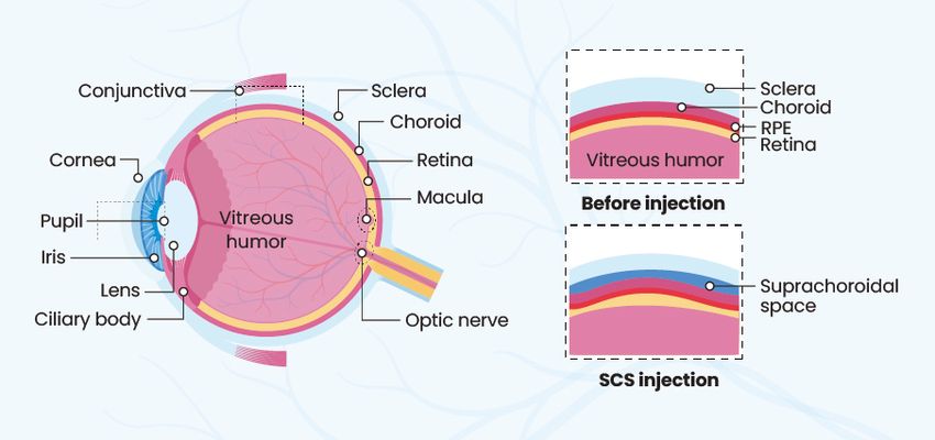 A schematic showing the layers of the eyeball and suprachoroidal space from a side view. A schematic showing the layers of the eyeball and suprachoroidal space from a side view.
