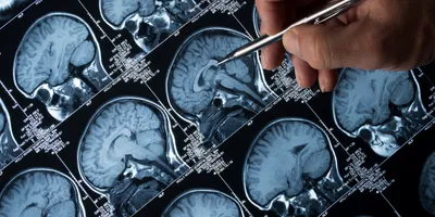 MRI Brain Scan of head and skull with hand pointing