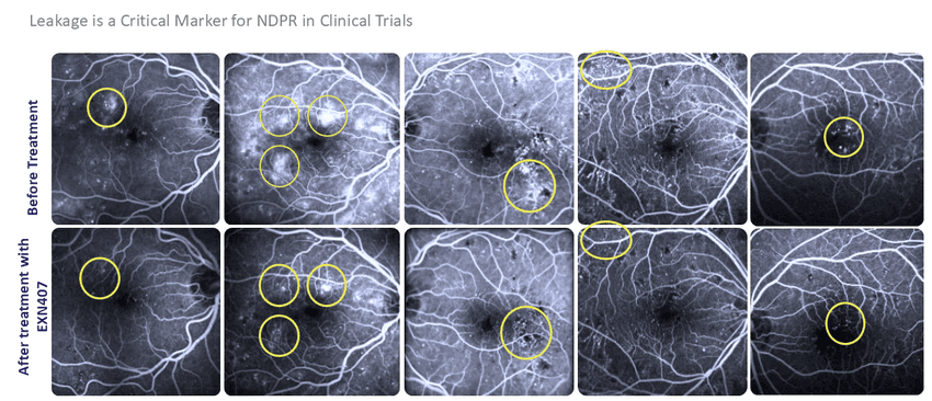 Side-by-side retinal scans showing reduced vascular leakage in diabetic retinopathy after EXN407 treatment. Side-by-side retinal scans showing reduced vascular leakage in diabetic retinopathy after EXN407 treatment.