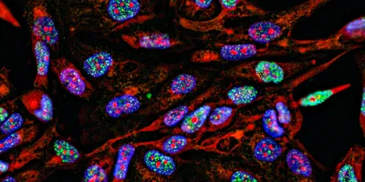 Fluorescent Imaging of cancer cells growing in 2D with nuclei in blue, cytoplasm in red and DNA damage foci in green. 
