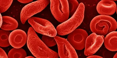 Red blood cells showing sickle cell disease