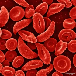 Red blood cells showing sickle cell disease