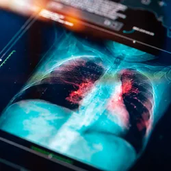 Medical MRI Scan of a lung on digital screen