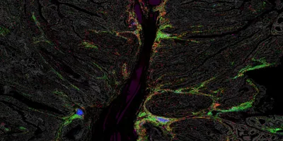 A microscopy image of a human colon polyp is brightly lit up in green, red, and blue.