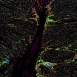 A microscopy image of a human colon polyp is brightly lit up in green, red, and blue.