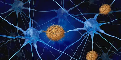 A rendering of blue neurons with yellow-orange amyloid plaques growing between them.