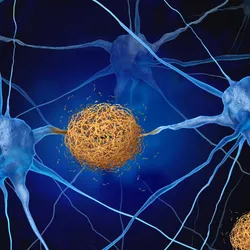 A rendering of blue neurons with yellow-orange amyloid plaques growing between them.