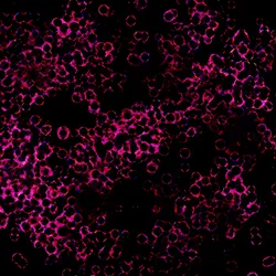 Fluorescence in situ hybridization cancer cells 