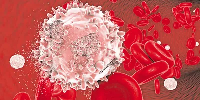 Visualization of red blood cells and a white blood cell indicative of acute myeloid leukemia.