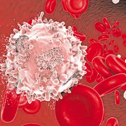 Visualization of red blood cells and a white blood cell indicative of acute myeloid leukemia.