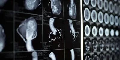 Medical imaging scans showing arteries and heart structures, relevant to gene therapy for heart condition.