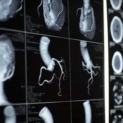 Medical imaging scans showing arteries and heart structures, relevant to gene therapy for heart condition.
