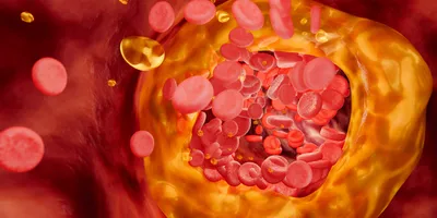 Blocked artery concept and human blood vessel as a disease with cholesterol fat buildup clogging. 