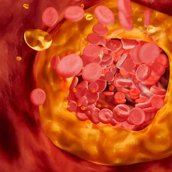 Blocked artery concept and human blood vessel as a disease with cholesterol fat buildup clogging. 
