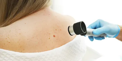 A dermatologist examines moles and skin growths on the patient's body using a dermatoscope. 