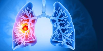 Illustration of human lungs showing a highlighted tumor in the left lung, with surrounding airways visible.