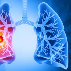 Illustration of human lungs showing a highlighted tumor in the left lung, with surrounding airways visible.