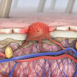 3d illustration of a cross-section of a cancer breaking the skin barrier.