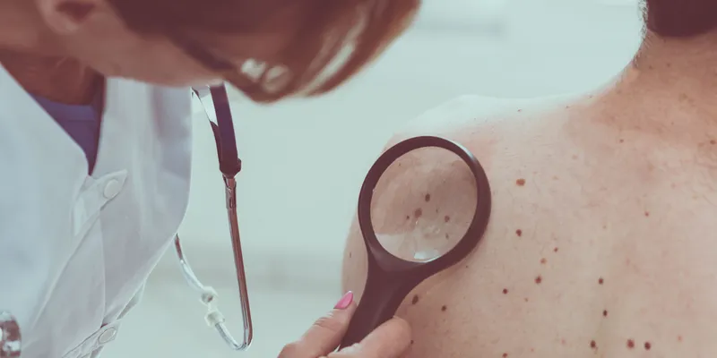 Doctor inspecting skin marks with magnifying tool 
