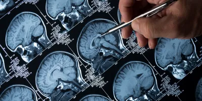 MRI Brain Scan of head and skull 