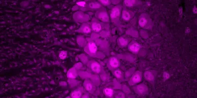 Fluorescent microscopy image showing a dense cluster of rounded cells stained in bright magenta against a darker purple background. The cells appear tightly packed, with visible nuclei and subtle variation in size and shape, forming a distinct band or layer within surrounding tissue.