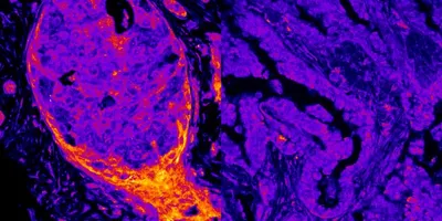 Cellular imaging of breast cancer 