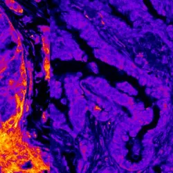 Cellular imaging of breast cancer 
