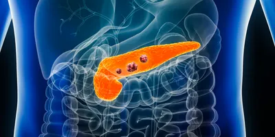 glp-1 and pancreatic cancer The effect of GLP-1R agonists on the medical triad of obesity, diabetes, | Cancer and Metastasis Reviews GLP-1 Receptor Agonists: Benefits and