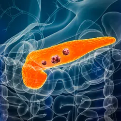 Pancreas or pancreatic cancer with organs and tumors or cancerous cells 3D rendering illustration with male body.
