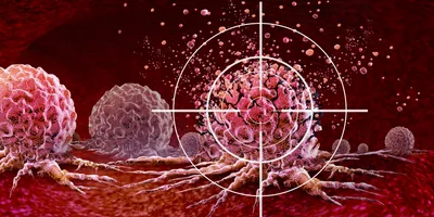 Ultrasound Cancer Treatment and new Cancer killing tumours therapy with vibrating molecules breaking the membranes of malignant tumor cells as an oncology therapy fighting Cancerous Growth and Metastasis.