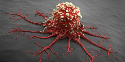 A 3D medical illustration of a cancer cell or tumor, featuring a main red mass covered in bumpy white textures with long, root-like tentacles branching outward across a gray surface.