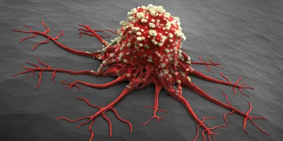 A 3D medical illustration of a cancer cell or tumor, featuring a main red mass covered in bumpy white textures with long, root-like tentacles branching outward across a gray surface.