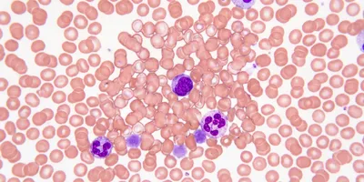 Close-up of blood cells highlighting B cells for therapy.