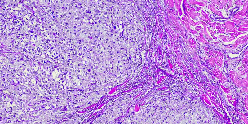 A purple microscopic photo of melanoma cancer cells