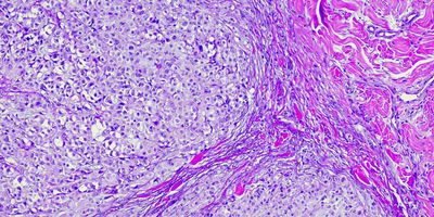 A purple microscopic photo of melanoma cancer cells