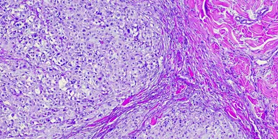 A purple microscopic photo of melanoma cancer cells