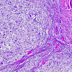 A purple microscopic photo of melanoma cancer cells