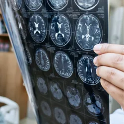 Elderly patient in hospital bed with a doctor holding onto images of MRI scans of the brain.