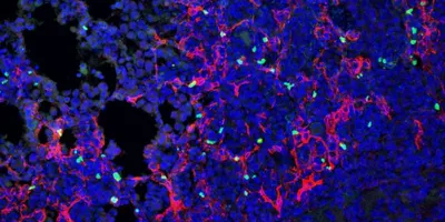 A microsopic close up of lunger cancer cells shown in blue and green.