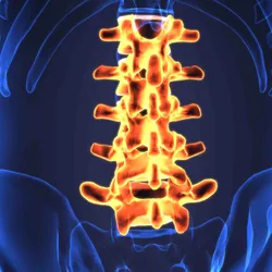 The lumbar spinal column shown in bright orange over a blue body background.