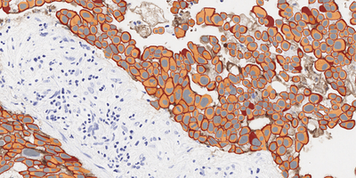 IHC tissue section with AI cell segmentation overlays color-coded by biomarker expression intensity for quantitative companion diagnostic scoring.